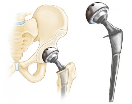 Designul tijei femurale și riscul de fractură periprotetică precoce după artroplastia totală de șold