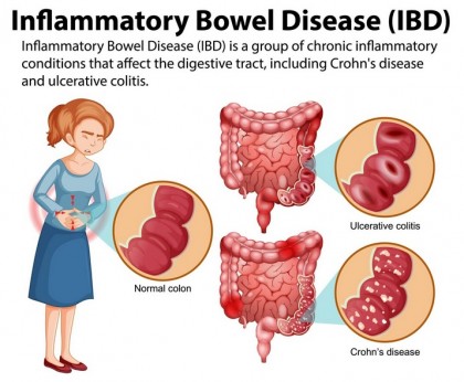 Organoidele și automatizarea testării medicamentelor: o nouă eră în tratamentul personalizat al bolilor inflamatorii intestinale