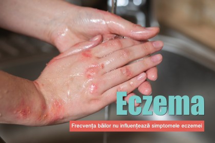 Frecvența băilor nu influențează simptomele eczemei