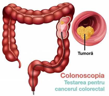 Rată scăzută de testare pentru cancerul colorectal (colonoscopie) la adulții de 45–49 de ani, în ciuda extinderii recomandărilor de screening