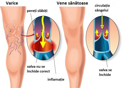 Varicele: de ce apar și ce opțiuni moderne de tratament există
