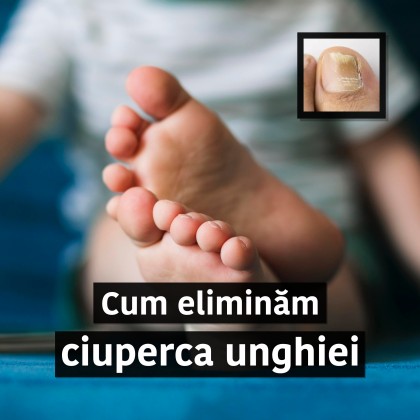 Cum eliminăm ciuperca unghiei de la picior