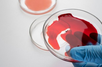 O proteină considerată „nemedicabilă” devine țintă terapeutică: inhibarea IGF2BP3 în leucemiile agresive