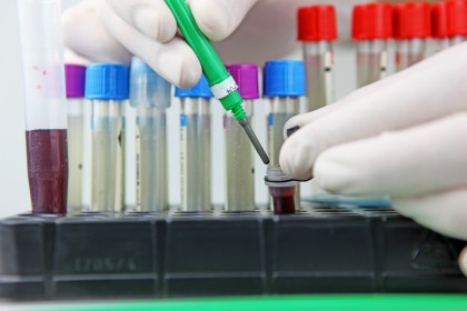 Un test rapid de 15 minute pentru hepatita C poate accelera diagnosticul și inițierea tratamentului