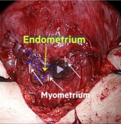 Tehnica de închidere a histerotomiei fără includerea endometrului la operația cezariană și impactul asupra defectelor cicatriciale uterine