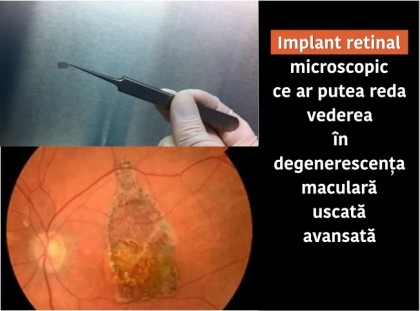 Implant retinal microscopic cu celule stem pentru degenerescența maculară uscată avansată