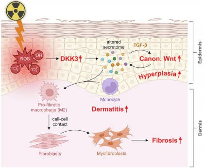 Fibrozele induse de radiații sunt asociate cu activarea proteinei Dickkopf 3, o posibilă țintă terapeutică emergentă