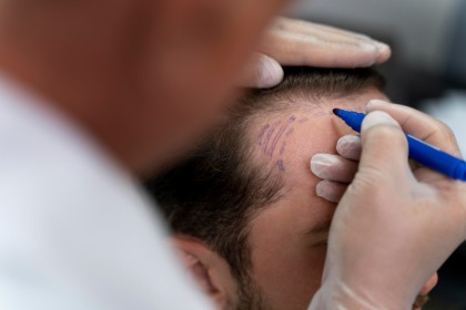 Transplant de păr: cât costă, cât durează și pe ce rezultate realiste te poți baza