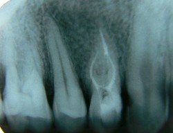 Radiografia in endodontie - cate radiografii sunt necesare, riscuri la expunere