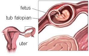 Sarcina extrauterina - ectopica