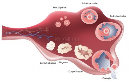 Sindromul de hiperstimulare ovariana