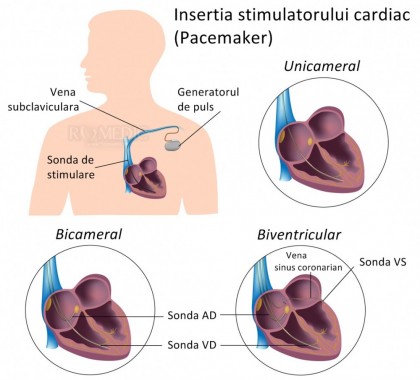 Pacemakerele - stimulatoarele cardiace