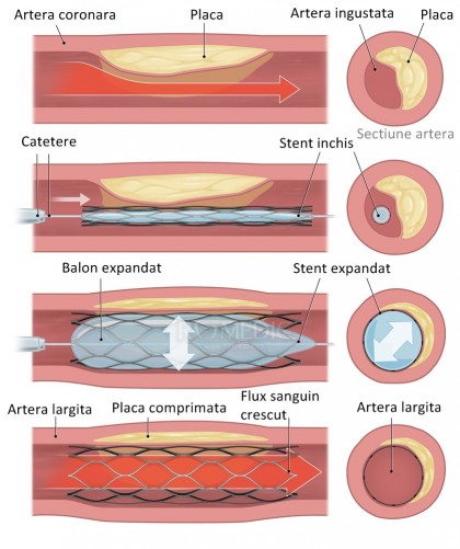 Stenturile coronariene