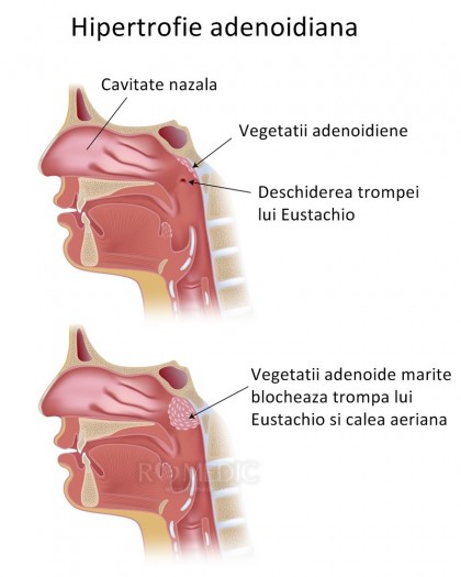 Adenoidita