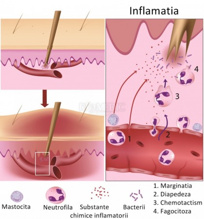 Reactia inflamatorie