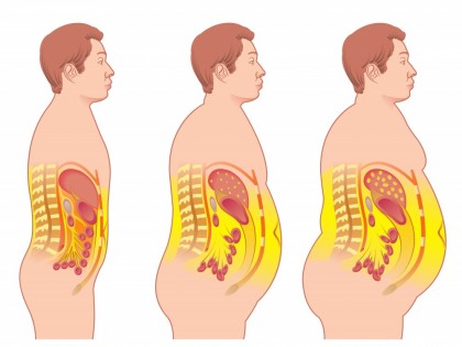 Sindromul metabolic