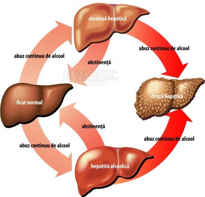 Ciroza hepatica alcoolica