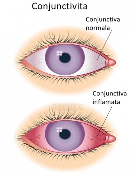 Conjunctivita infectioasa