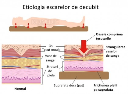 Escarele de decubit (leziunile de presiune)