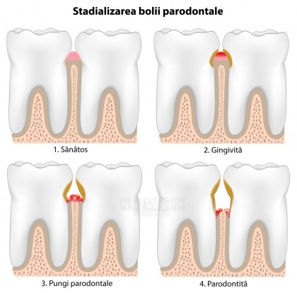 Parodontoza