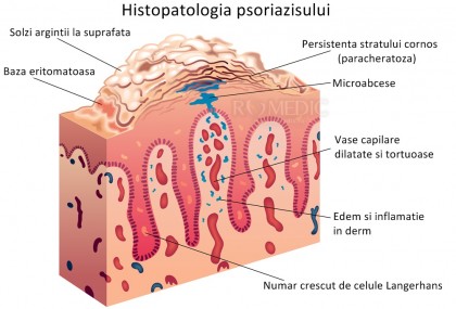 Psoriazis pustular