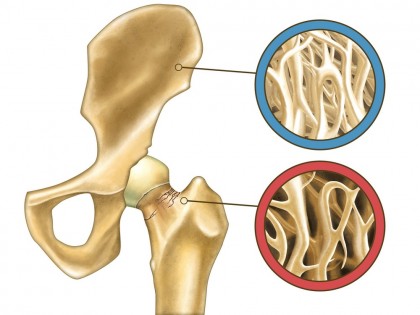 Osteoporoza secundara