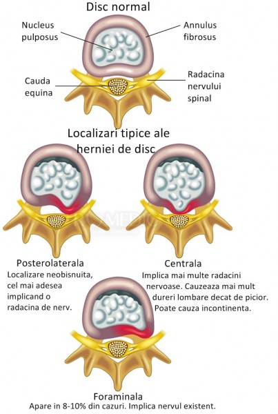 Discopatia lombara