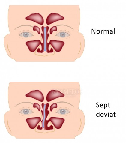 Deviatia de sept nazal