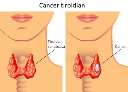 Cancerul tiroidian