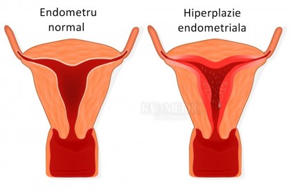 Hiperplazia endometrială