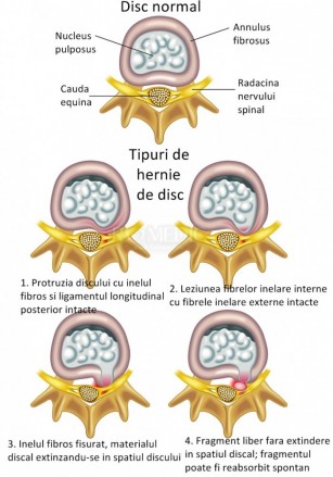 Electrostimularea musculara si durerile de spate – Blog Beurer Romania