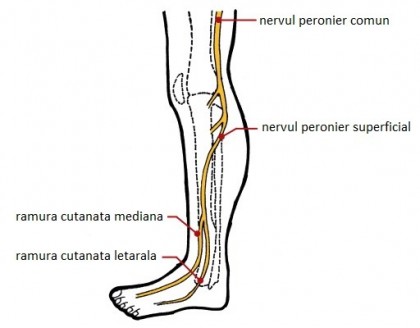 Neuropatia peronieră - paralizia nervului peronier