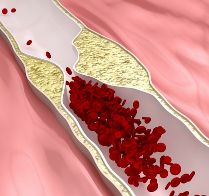 Arterioscleroza