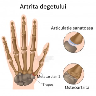 Dureri la articulațiile degetelor - ce ar putea fi? (diagnostic diferențial)