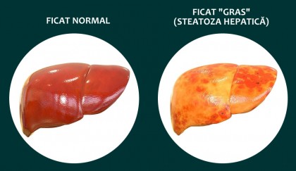 Steatoza hepatică non-alcoolică (NAFLD)