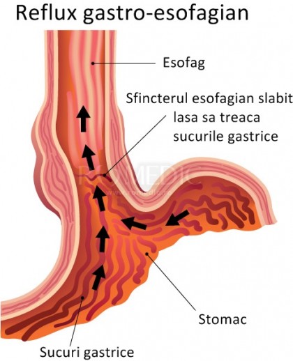 Investigarea fenomenelor de reflux digestiv