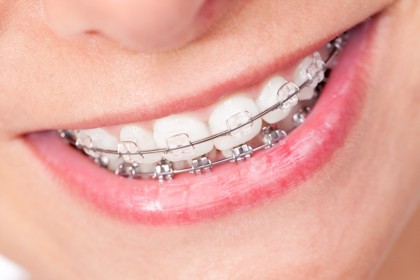 Aparatele dentare ortodontice