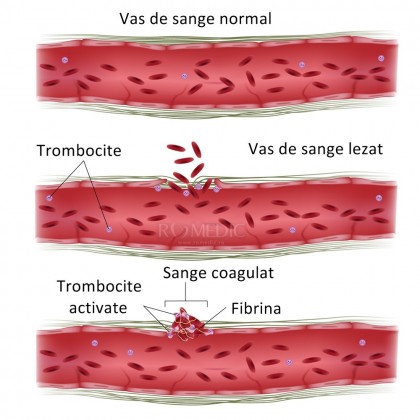 Disfibrinogenemie