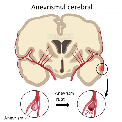 Anevrism cerebral