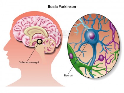 Parkinson