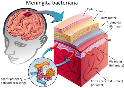 Meningita bacteriana acuta