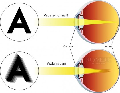 Astigmatismul