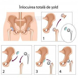 descrierea durerii în articulația șoldului)