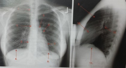 Radioanatomia aparatului respirator