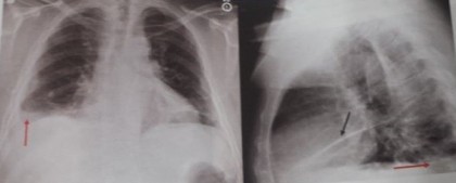 Imaginea radiologică patologică a cutiei toracice