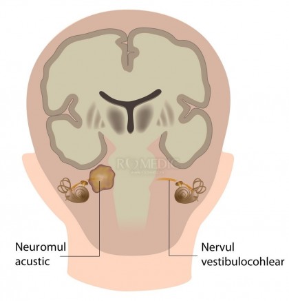 Neuromul acustic - schwanomul vestibular