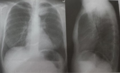 Imaginea radiologică patologică a plămânilor