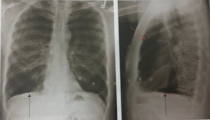 Emfizemul pulmonar pe radiografia toracică