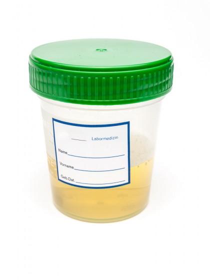 Boala Hartnup (Sindromul Hart)