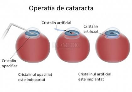 Cataracta si implantul de cristalin